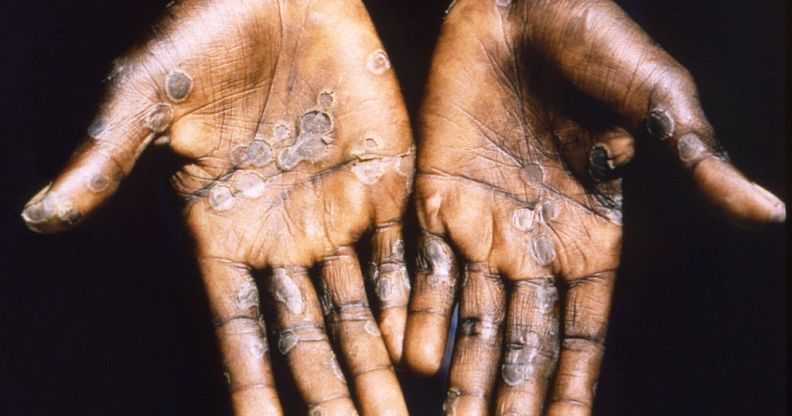 Mpox Outbreak: Stigma and lack of awareness hampering efforts to curb spread – GHS
