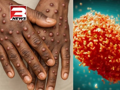 22 new Mpox cases recorded; total cases now 446