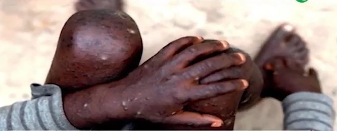 Mpox cases now 346 – Ghana Health Service