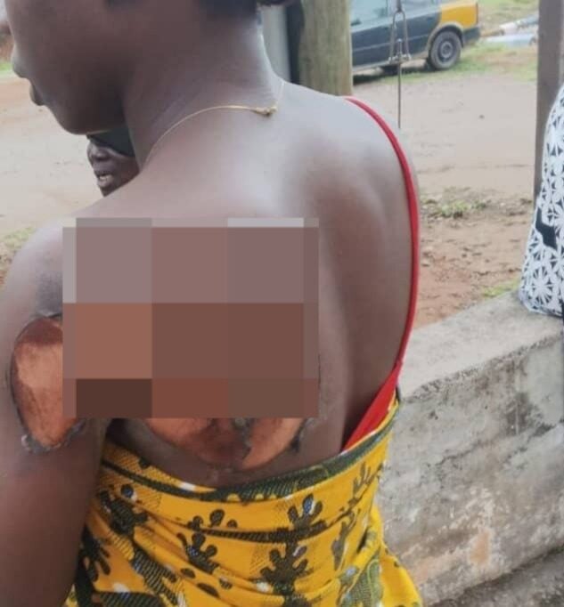 Jealous boyfriend allegedly sets girlfriend on fire, stepdaughter sustains burn injury at the back