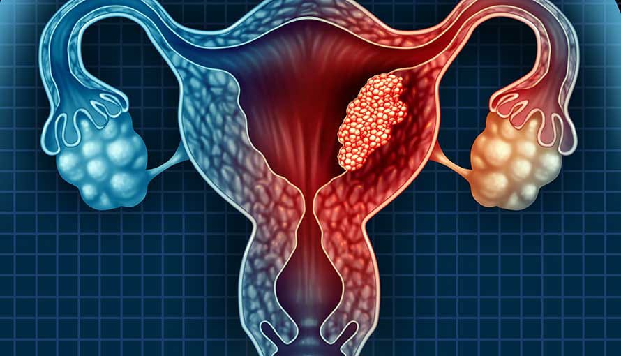 Obesity, diabetes, and PCOS linked to rising endometrial cancer risk – Doctor warns